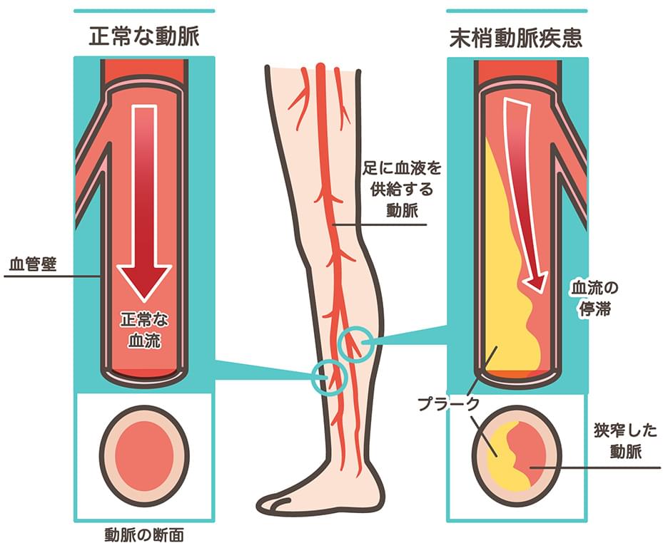 ふくらはぎ の 動脈 硬化